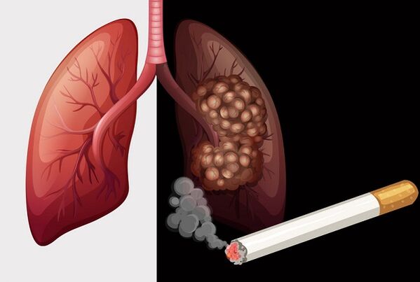 rokerslongen en gezonde longen